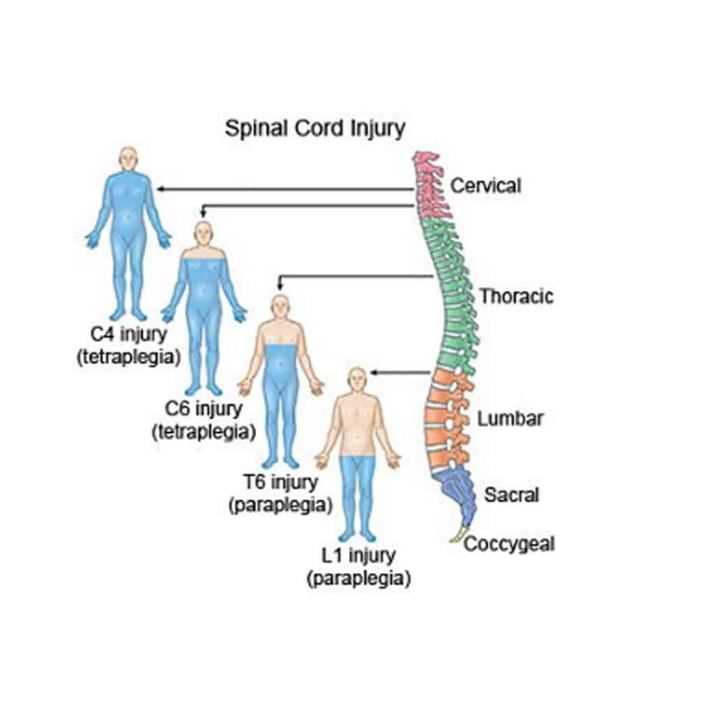 Legal guide for spinal cord injury victims